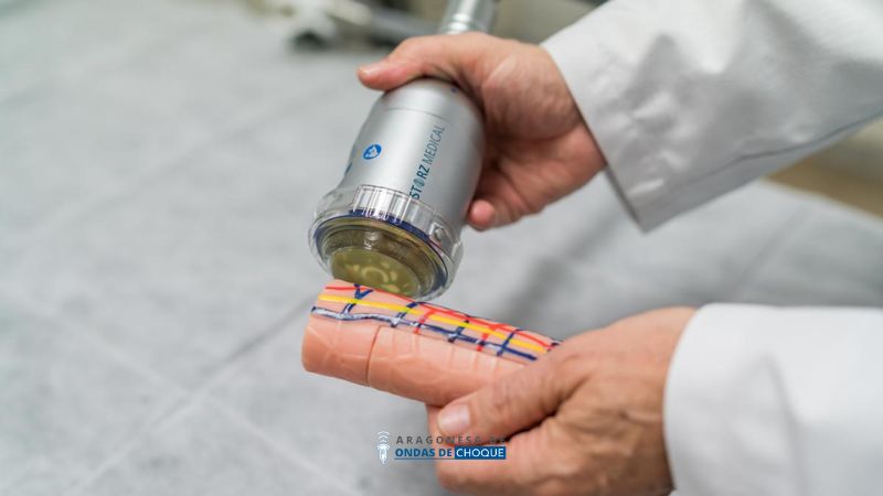 Ondas de choque en zaragoza para urologia pene