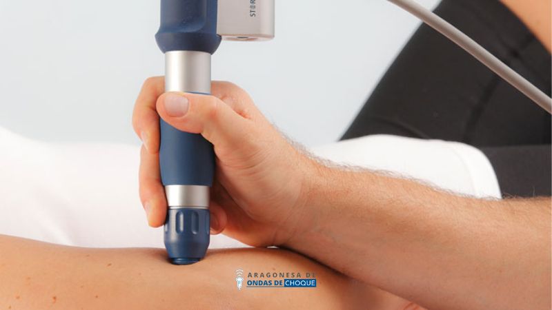 Ondas de choque para litiasis urinaria en zaragoza
