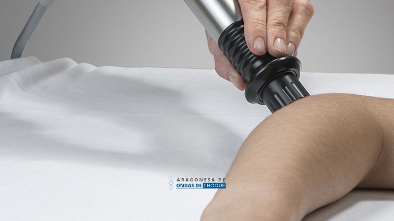 ondas de choque para epicondilitis en Zaragoza