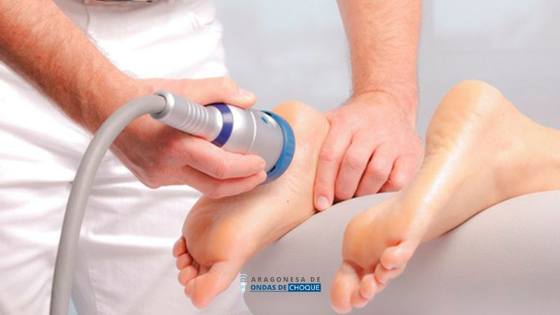 ondas de choque para espolon calcaneo en zaragoza como romper curar dolor talon