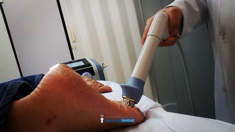 ondas de choque para neuroma de morton en zaragoza