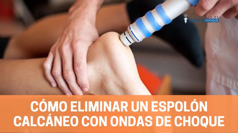 Cómo eliminar un espolón calcáneo con ondas de choque