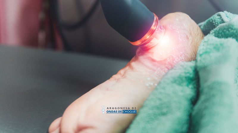 Curar la fascitis plantar tratamiento ondas de choque fisioterapia