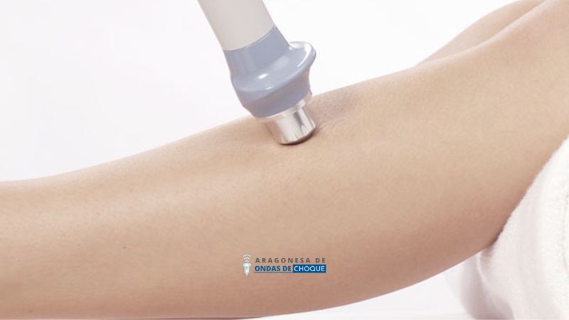 Fisioterapia ondas de choque periostitis en zaragoza